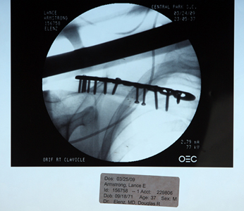 Lance Armstrong shoulder xray